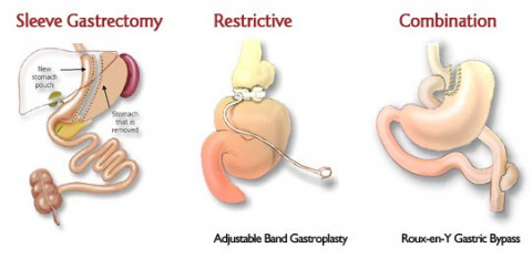 Bariatric (Weight Loss) Surgery - Assessment Services